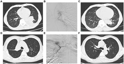 Drug-eluting beads bronchial arterial chemoembolization vs. conventional bronchial arterial chemoembolization in the treatment of advanced non-small cell lung cancer